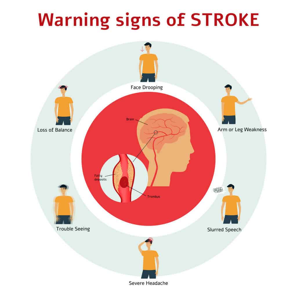 home care for stroke patients start with recognizing the signs of a stroke