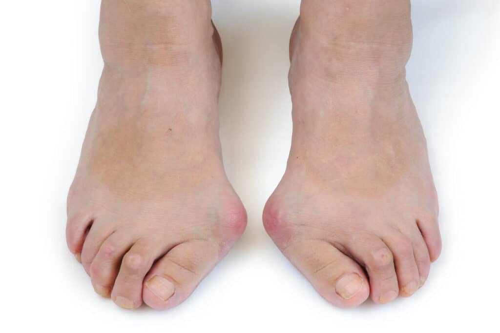 elderly feet with bunion