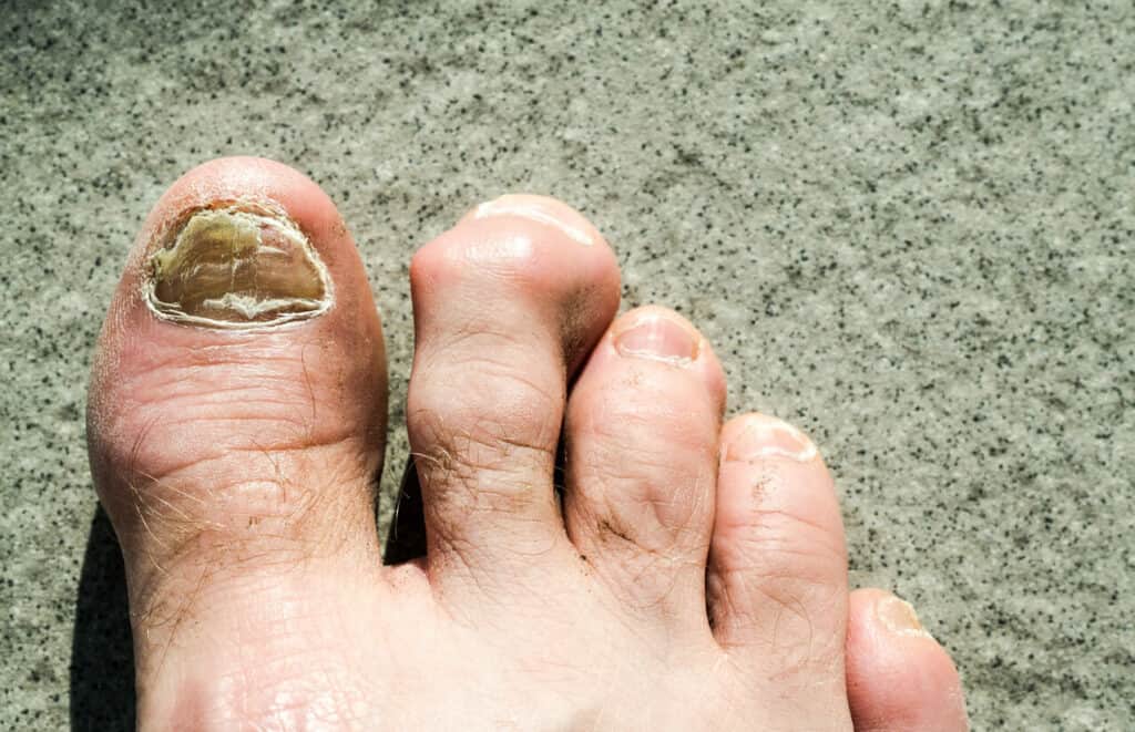elderly feet suffering from hammertoes