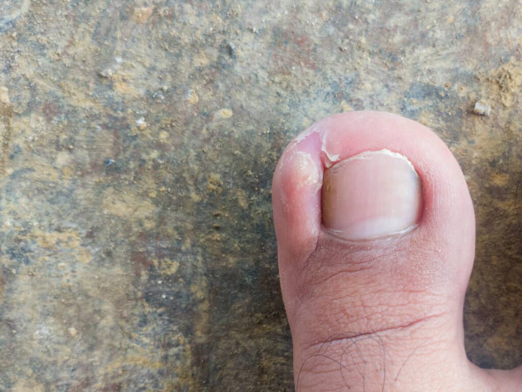 older person foot with ingrown toenails