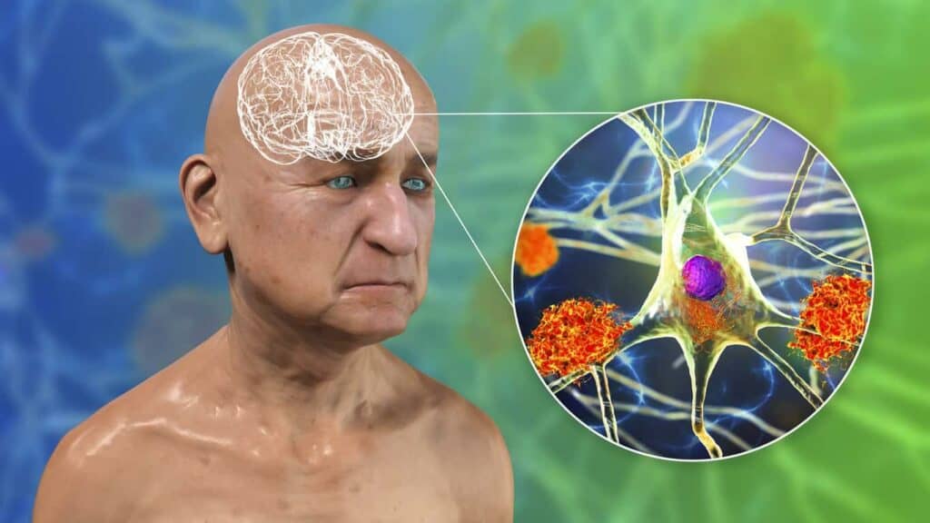 elderly’s brain graphic with vascular dementia - vascular dementia stages