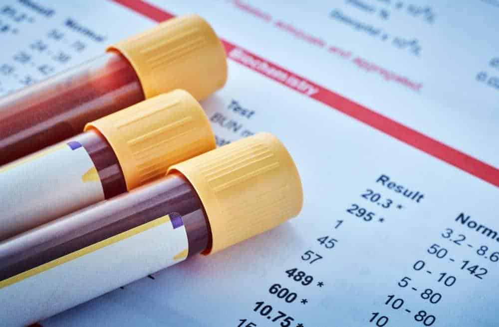 Vials of blood above some documents showing blood test results.