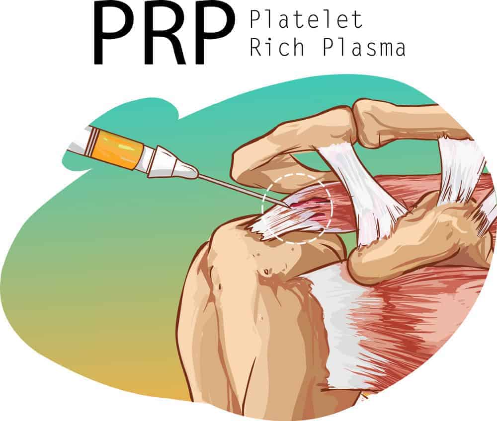 PRP for muscular injury - sports therapy treatment