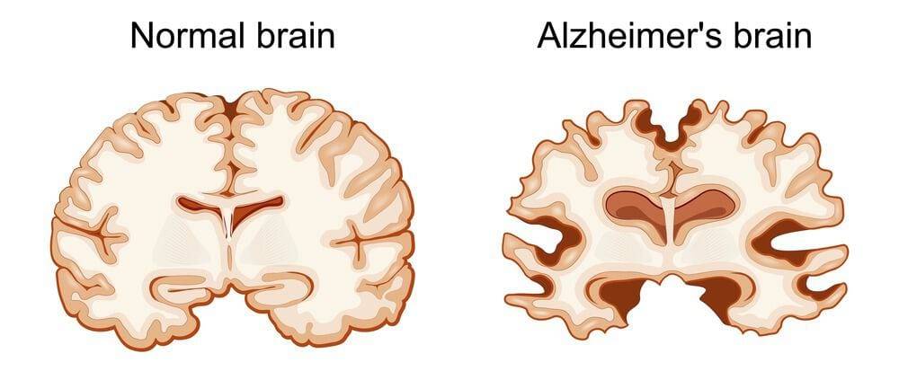 An image of a normal brain compared to that of Alzheimer's brain/ dementia care